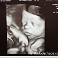 baby ultrasound 8